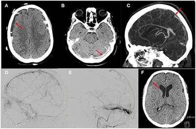 Cerebral venous sinus thrombosis with an acute subdural hematoma treated with endovascular intervention: A case report